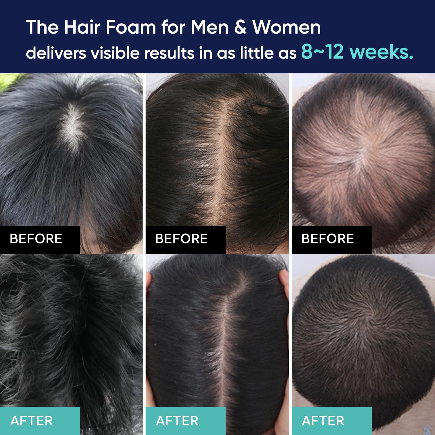 Kirkland Minoxidil